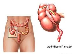 apendicite-aguda
