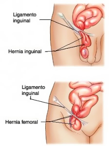 hernia-abdominal-04