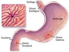 Úlcera Gastrica