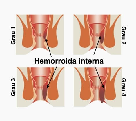 hemorroida inflamada: grau de evolução