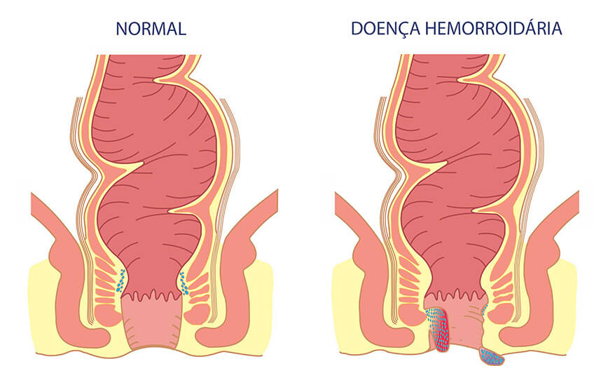 Qual é o Médico Especialista que Cuida e Trata Hemorroidas?