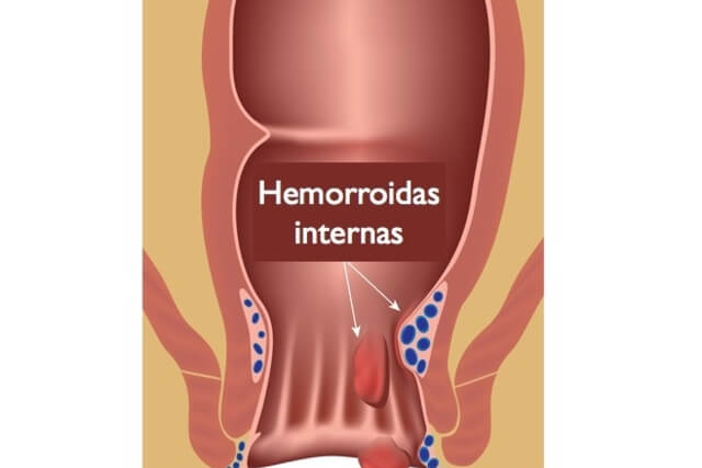 remédio para hemorroida interna: imagem ilustrativa da doença